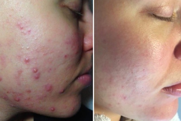 Onderhuidse puistjes: Oorzaken, behandelingen & tips | GetSpoiled